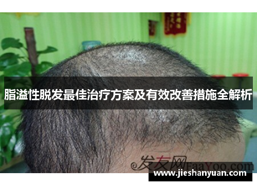 脂溢性脱发最佳治疗方案及有效改善措施全解析